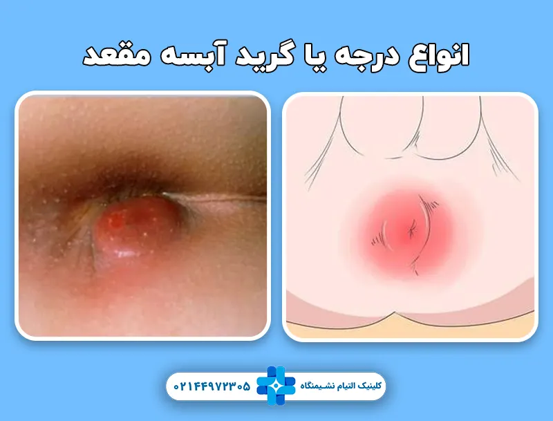 انواع درجه یا گرید آبسه مقعد