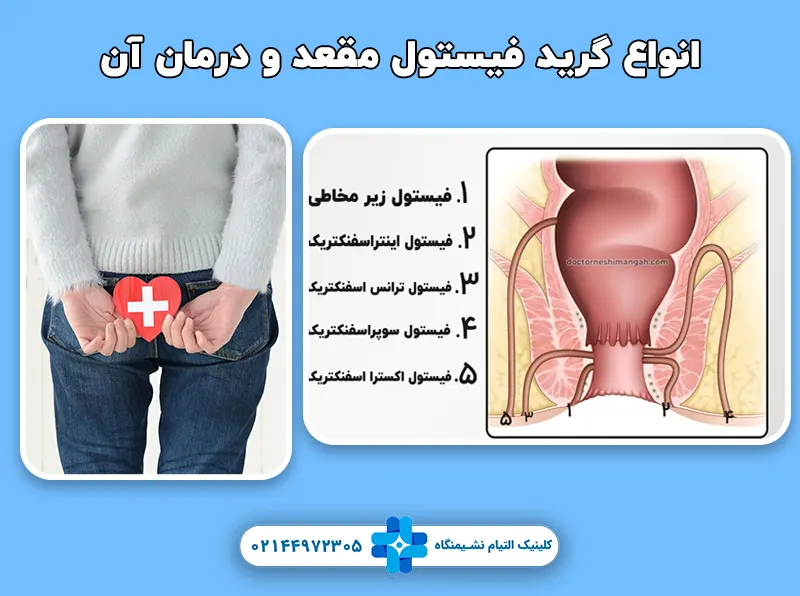 انواع درجه یا گرید فیستول مقعد و درمان هر کدام