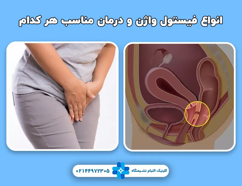 انواع فیستول واژن و درمان مناسب هر کدام