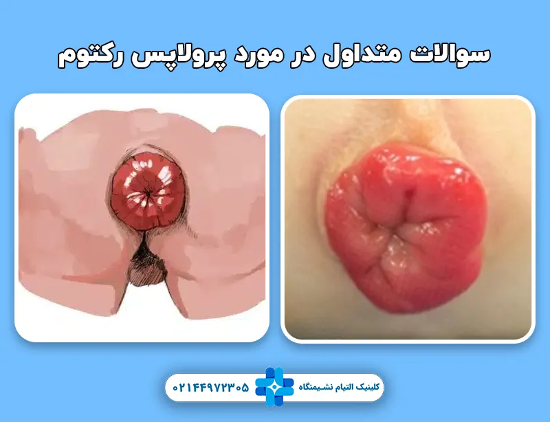 پاسخ به تمامی سوالات در مورد پرولاپس رکتوم