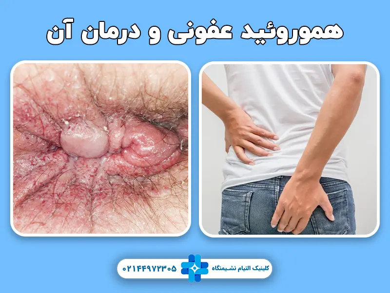 هموروئید عفونی و درمان آن