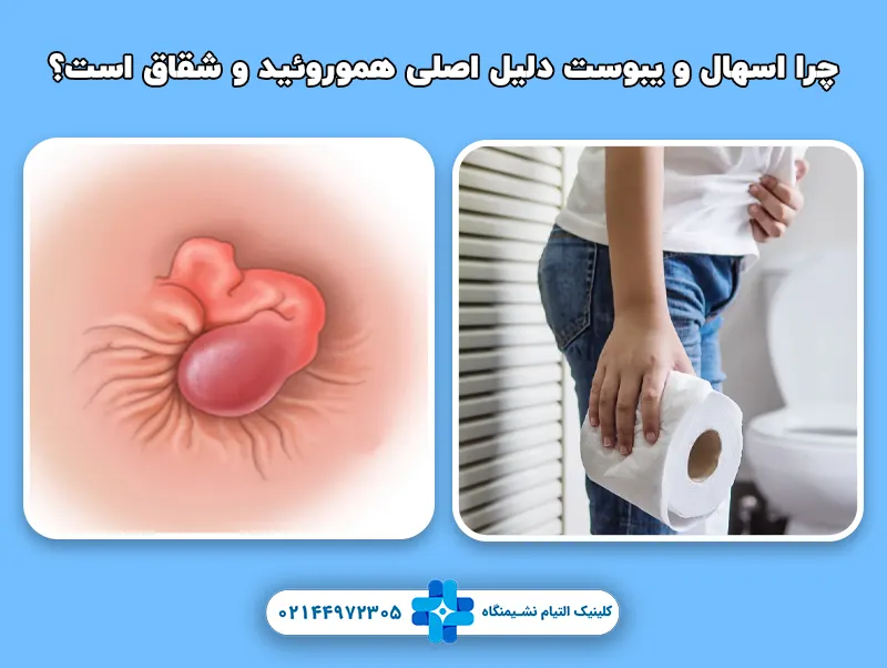 چرا اسهال و یبوست دلیل اصلی هموروئید و شقاق است؟
