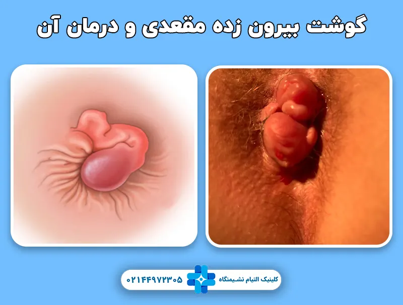 گوشت بیرون زده مقعدی