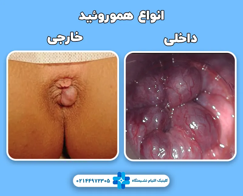 انواع هموروئید