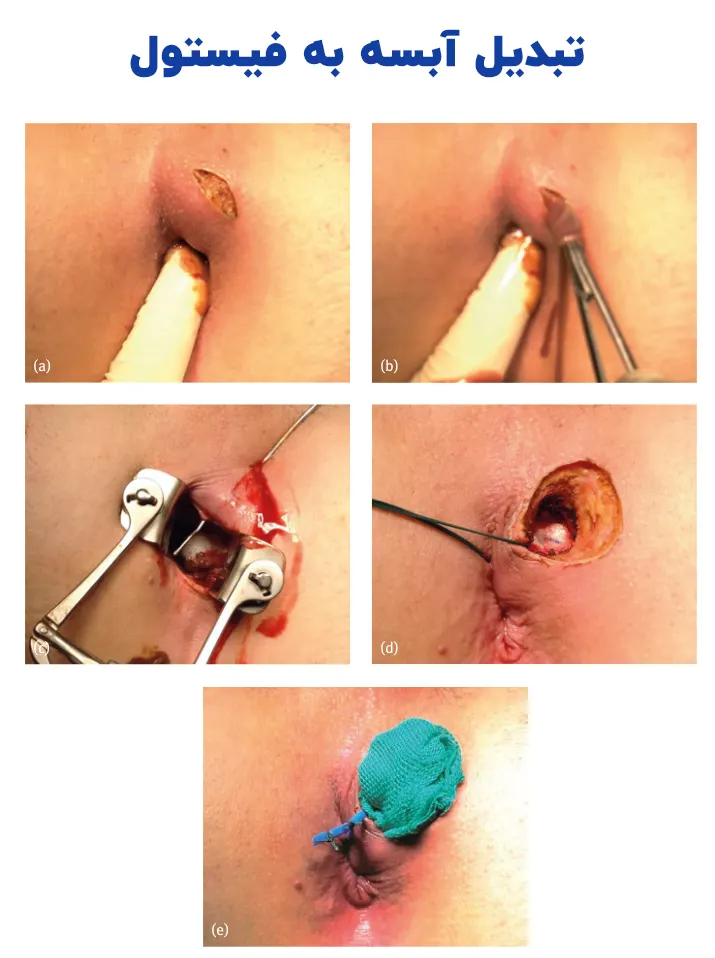 تبدیل آبسه به فیستول