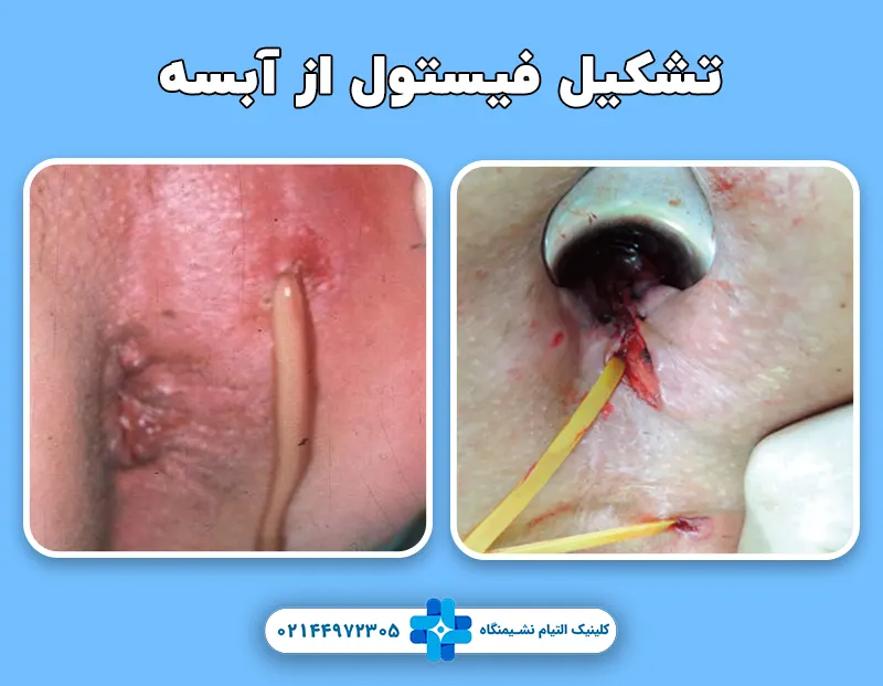 تبدیل آبسه به فیسول مقعد