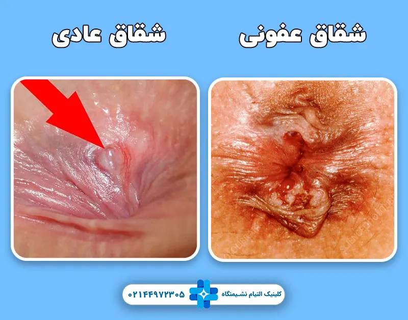 تفاوت شقاق عفونی و عادی