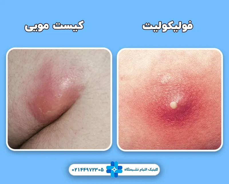تفاوت فولیکولیت با کیست مویی