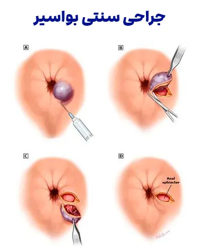جراحی سنتی بواسیر