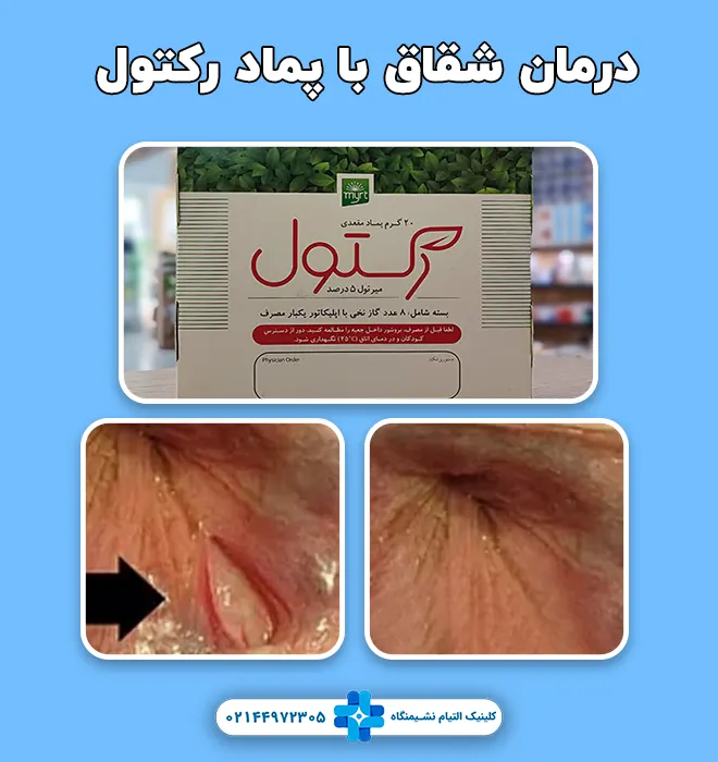 درمان شقاق با پماد رکتول