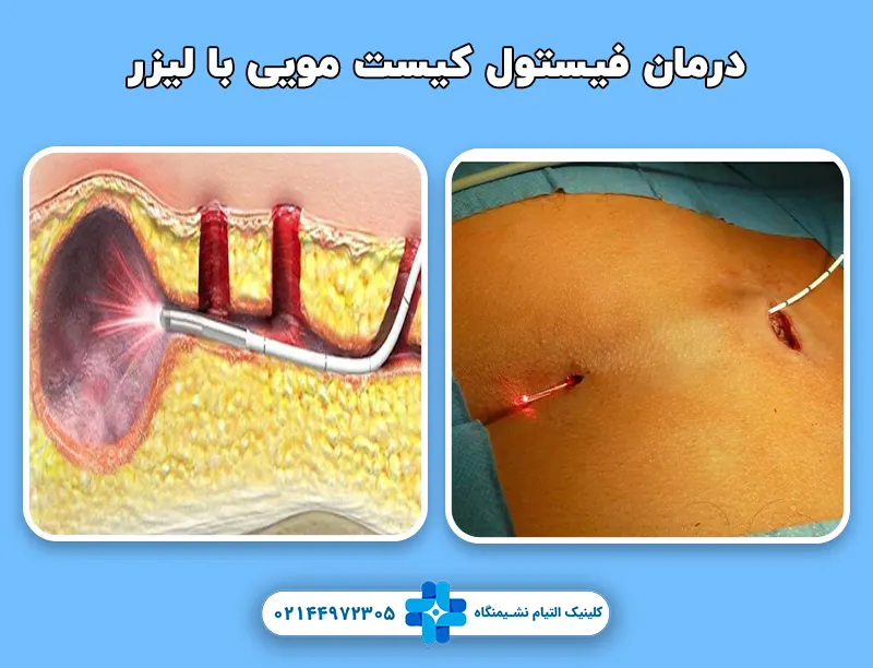 درمان فیستول کیست مویی با لیزر