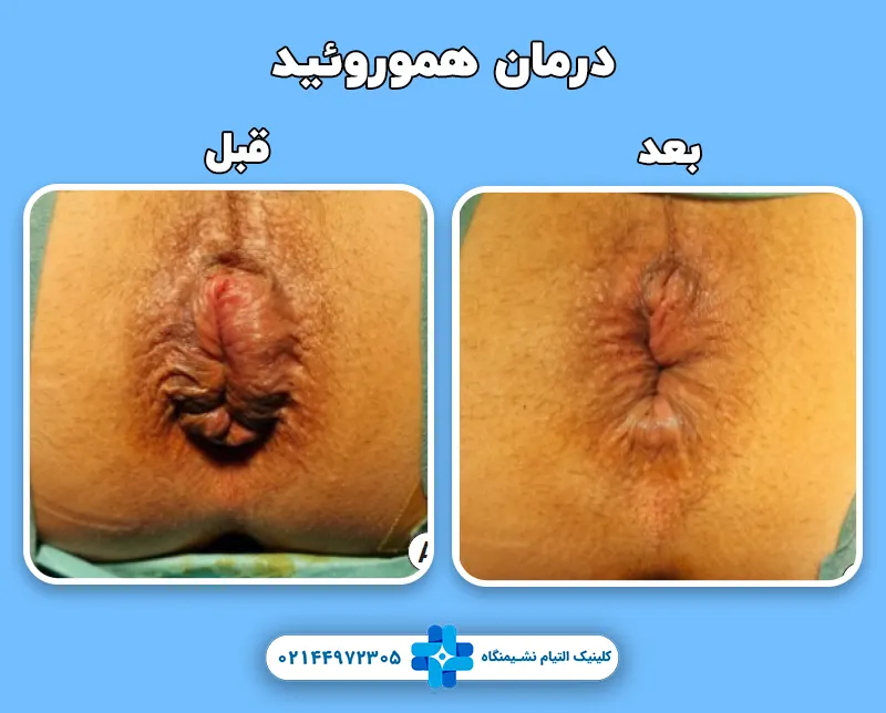 درمان هموروئید قبل بعد