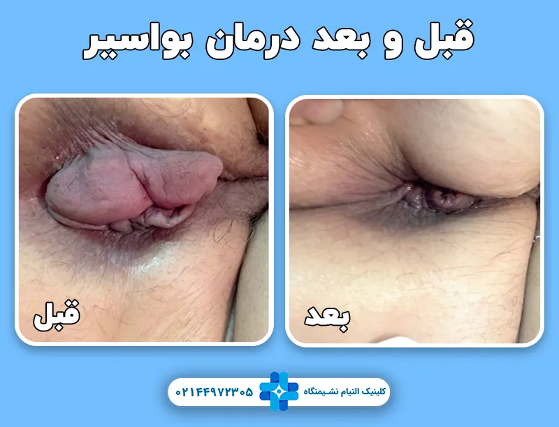 درمان هموروئید قبل بعد