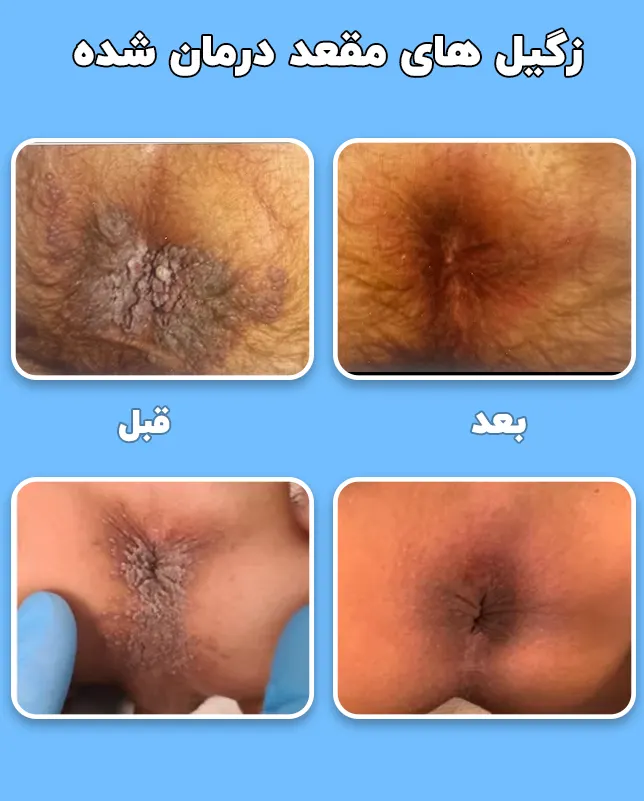 زگیل های مقعد درمان شده