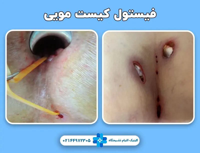 فیستول کیست مویی