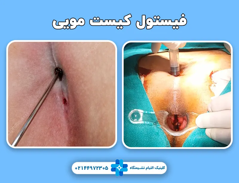 فیستول کیست مویی