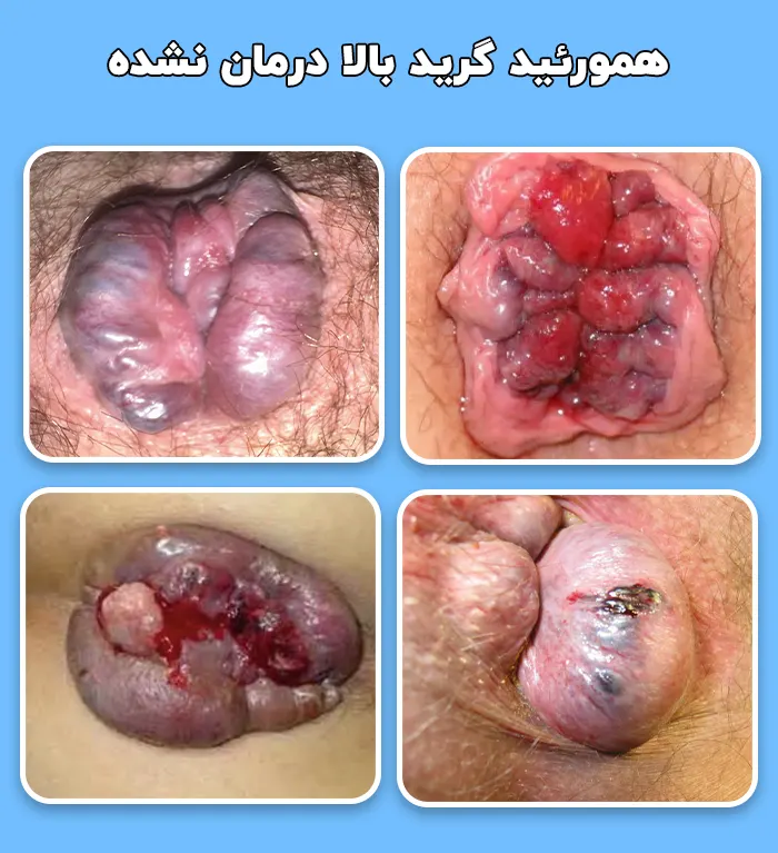 خطرات درمان نکردن هموروئید