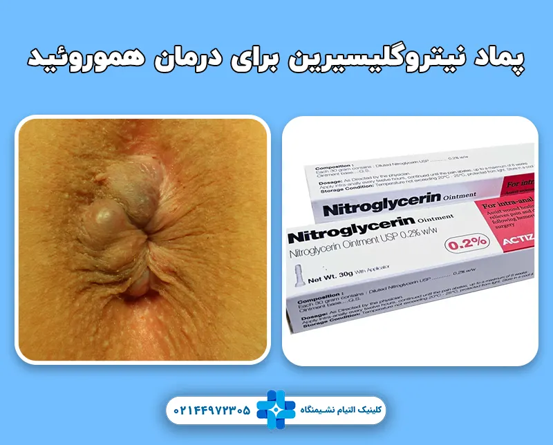 پماد نیتروگلیسیرین برای درمان هموروئید