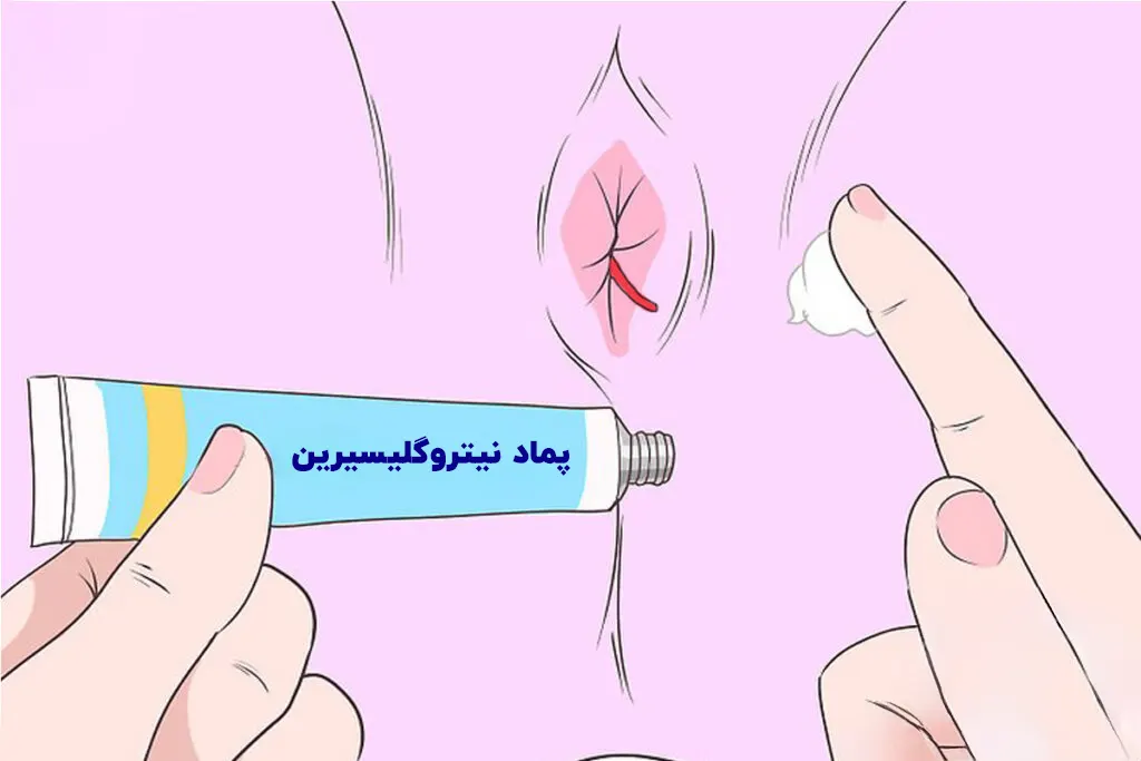 پماد نیتروگلیسیرین