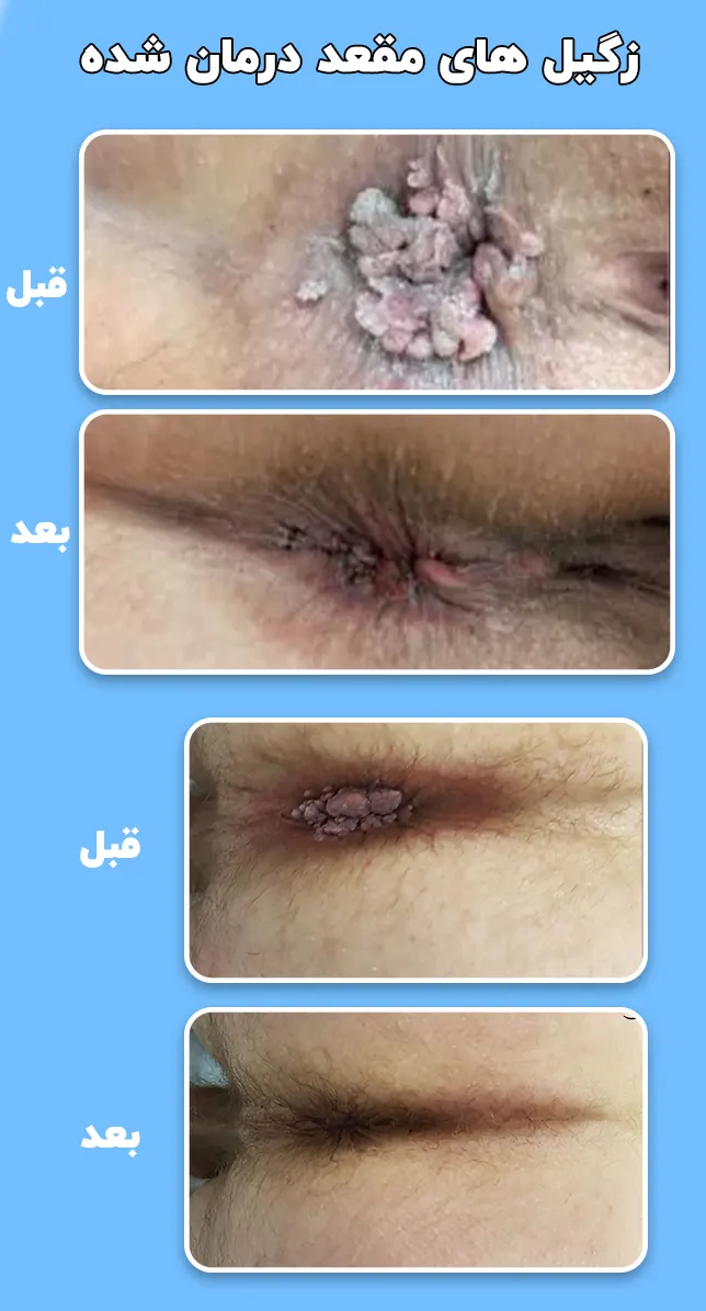 زگیل های مقعد درمان شده