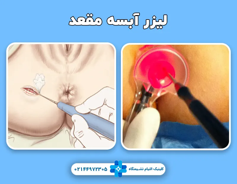 لیزر آبسه مقعد