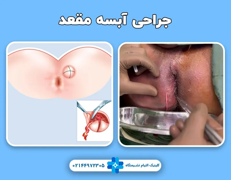 جراحی آبسه مقعد