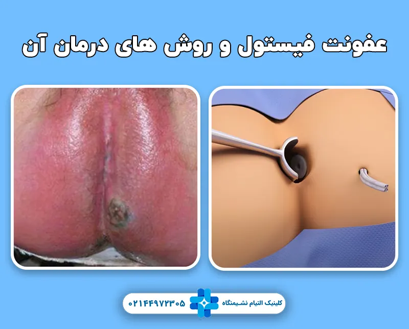 عفونت فیستول مقعدی و درمان