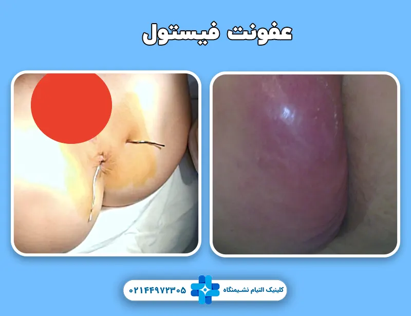 عفونت فیستول مقعدی