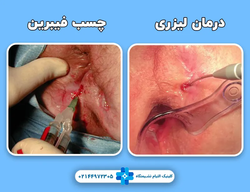 درمان فیستول مقعد