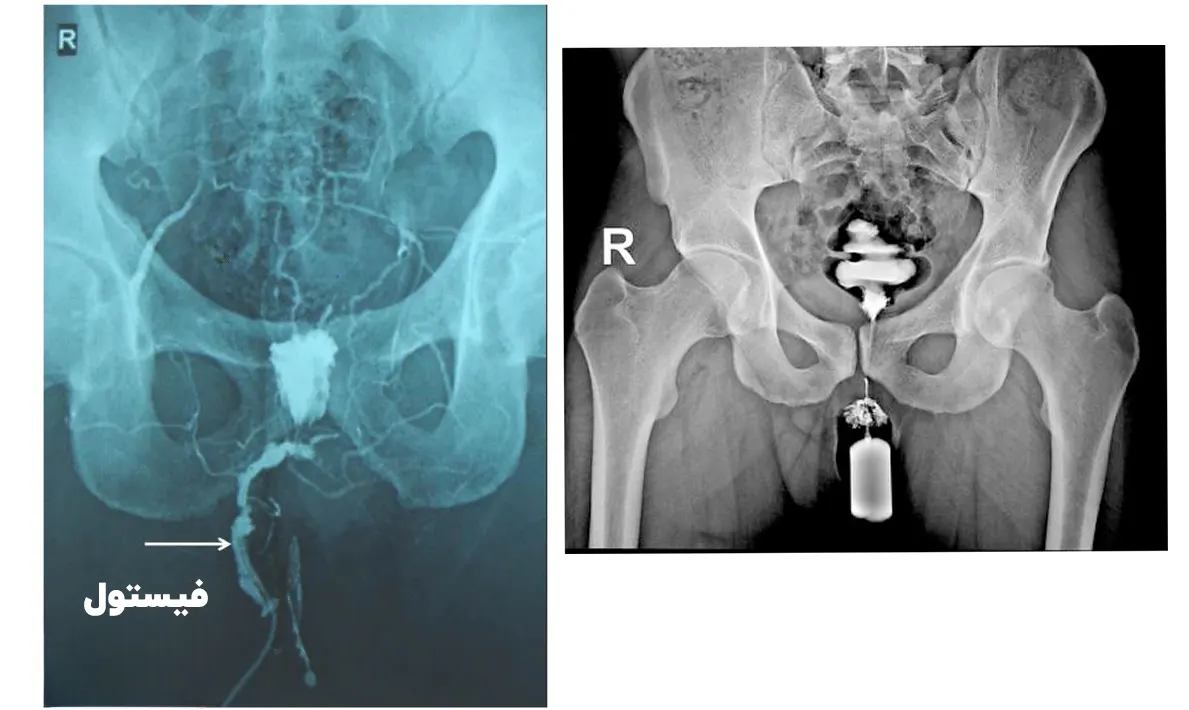 فیستولوگرافی