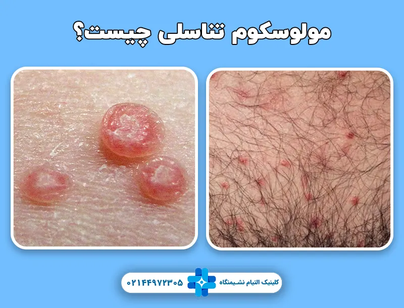 مولوسکوم تناسلی