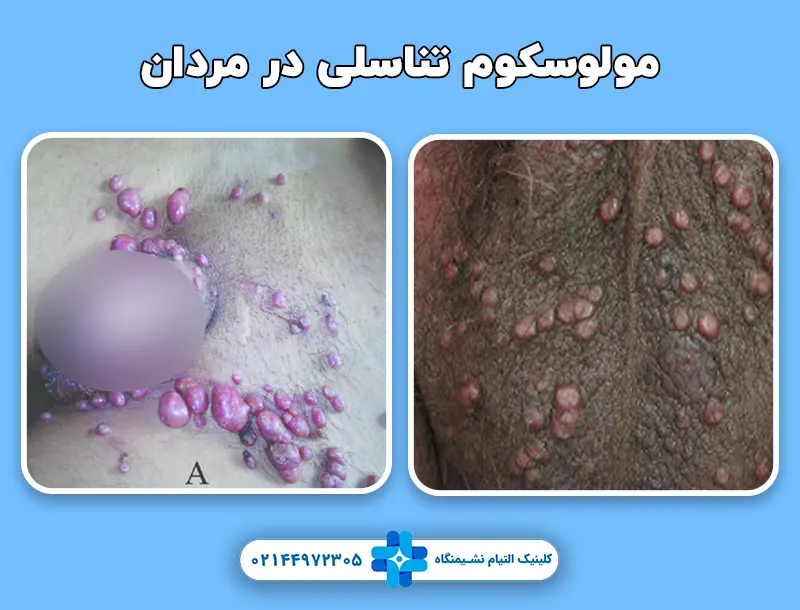 مولوسکوم تناسلی در مردان