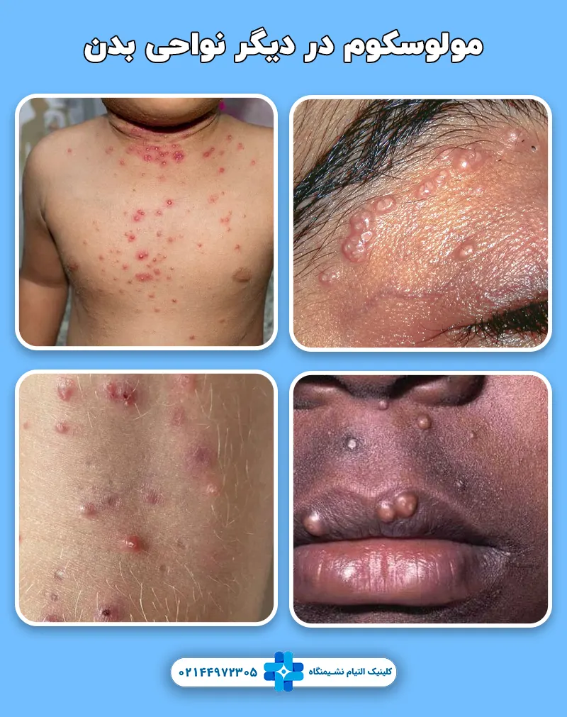 عکس مولوسکوم