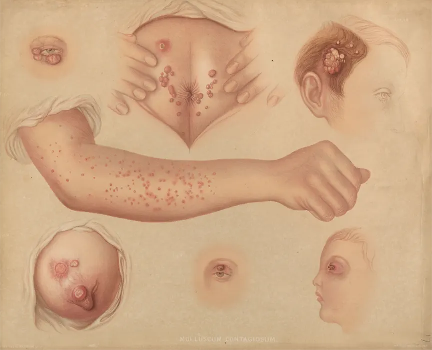 مولوسکوم تناسلی