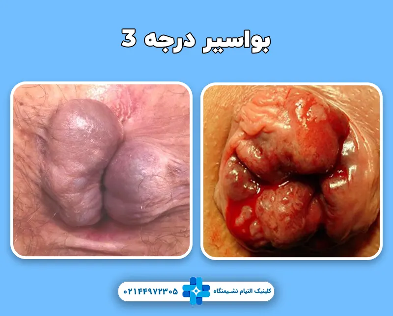 بواسیر درجه 3