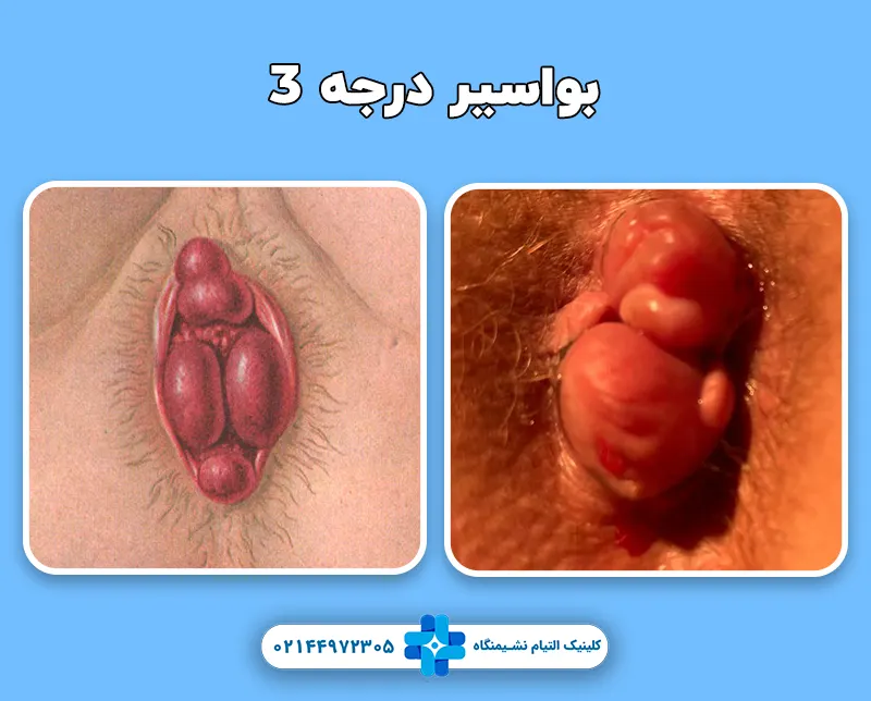 بواسیر درجه 3