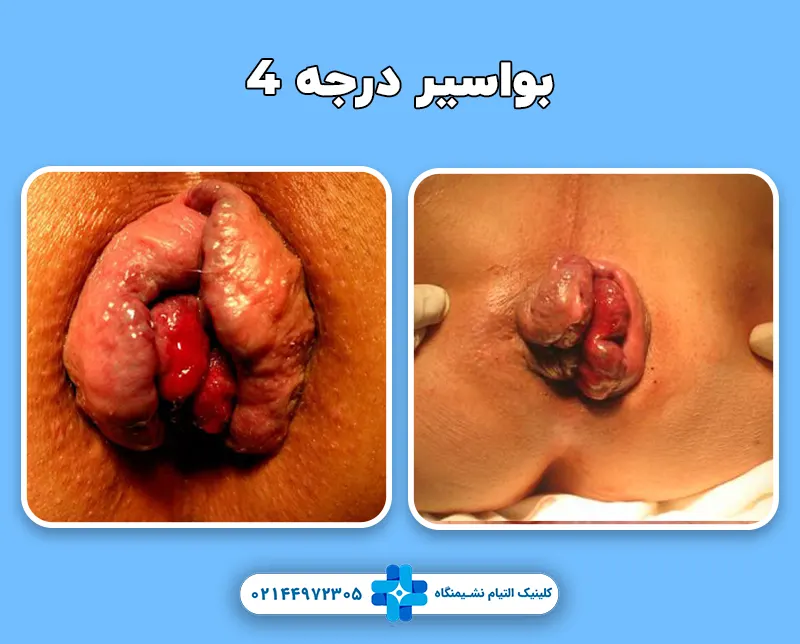 بواسیر درجه 4