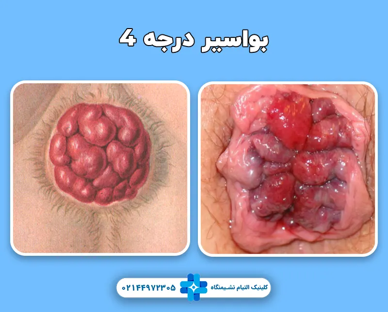بواسیر درجه 4