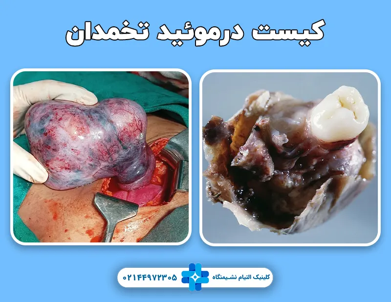 کیست درموئید تخمدان