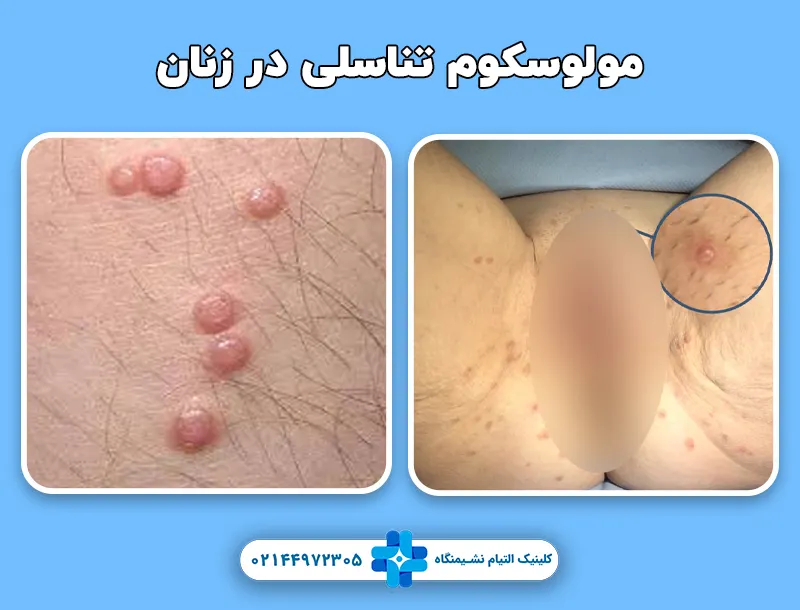 مولوسکوم تناسلی در زنان
