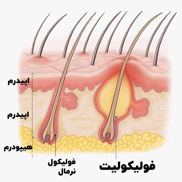 فولیکولیت چیست