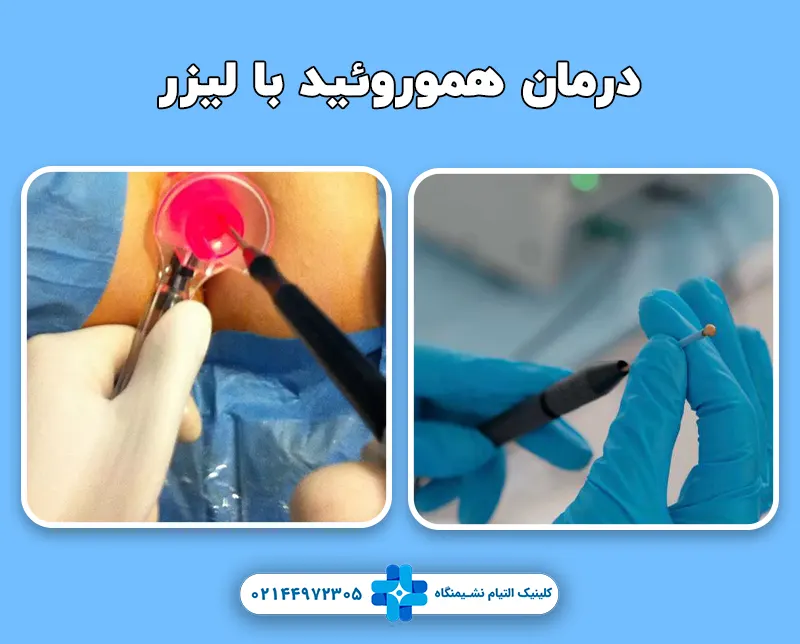 درمان بواسیر درجه 3 و 4 با لیزر