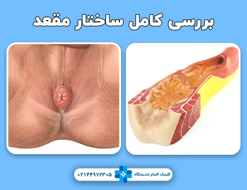 ساختار مقعد