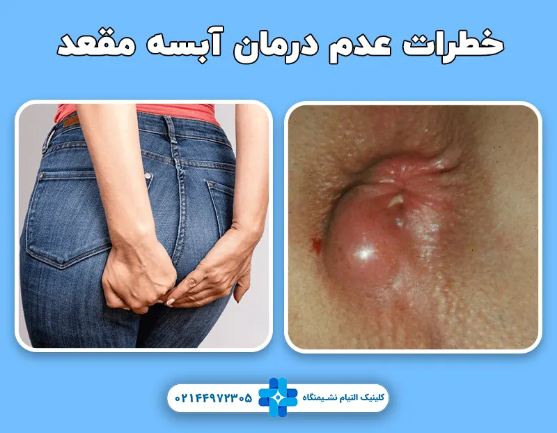 خطرات عدم درمان آبسه مقعد