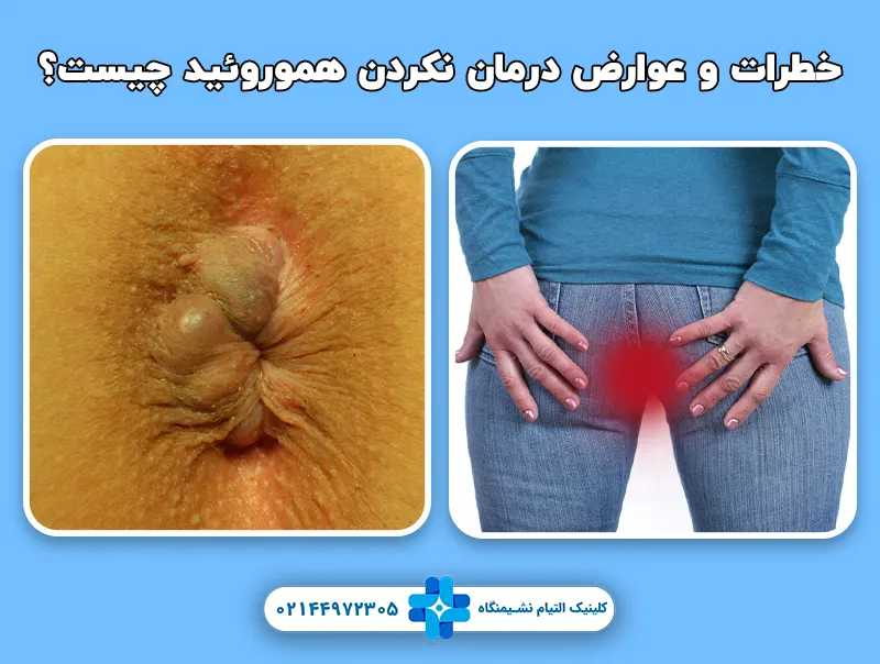 خطرات و عوارض درمان نکردن هموروئید چیست؟