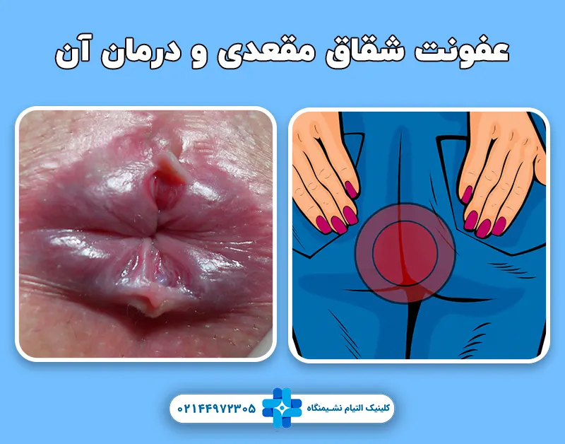 عفونت شقاق مقعدی