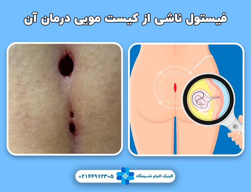 فیستول ناشی از کیست مویی