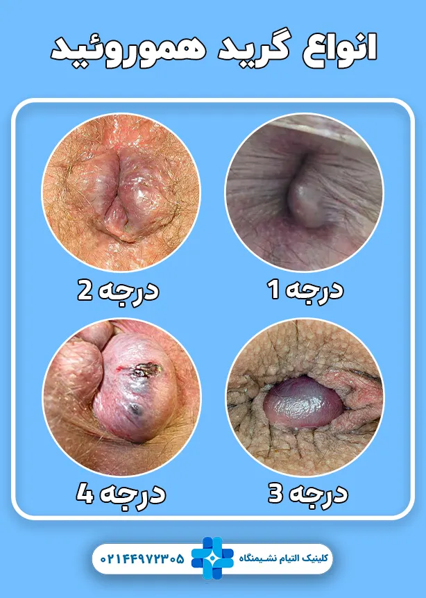 انواع گرید هموروئید