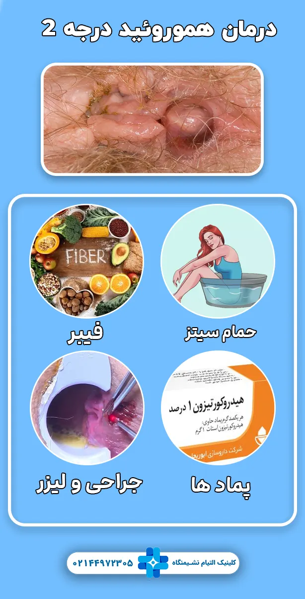درمان برای هموروئید درجه 2