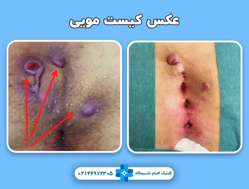 عکس کیست مویی